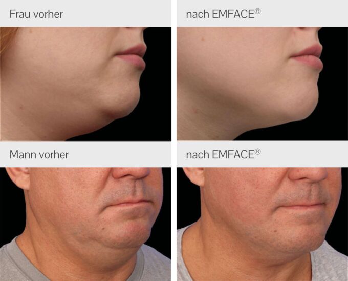 4 Vergleichsfotos erfolgreicher Behandlung zur Doppelkinn-Entfernung bei Mann & Frau. Links oben ist weibliches Doppelkinn vor EMFACE® Behandlung. Rechts eine schöne Kinnkontur nach entfernten Doppelkinn. Darunter sich Abbildungen vom Männerkinn zu sehen.