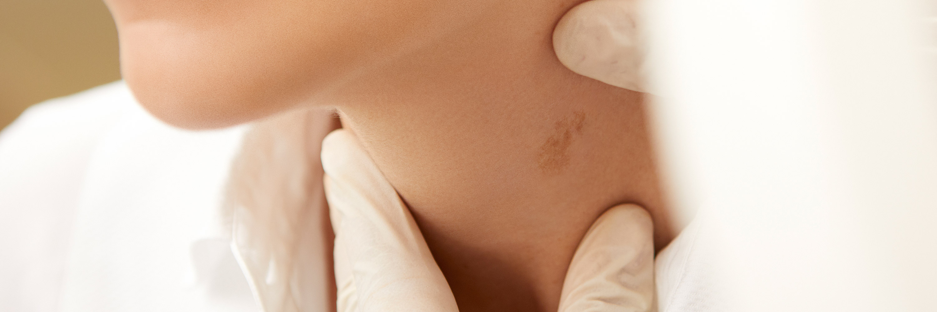 Die Haut am schönen Hals einer Patientin wird von einer Kosmetikerin in Plastikhandschuhen vor einer Behandlung mit der Dermamelan®-Methode untersucht. Ein unschöner Pigmentfleck ist deutlich zu sehen. Es sieht nach Melasma auf einer makellosen Haut aus.